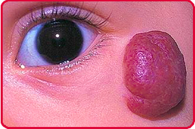 Hemangioma