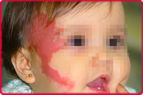 Mancha de vino de Oporto