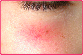Telangectasia facial